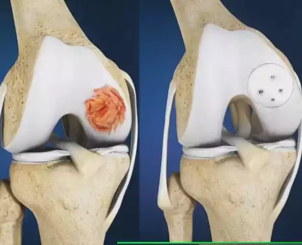 Cartilage Transplants
