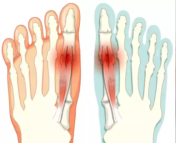 Hallux Valgus
