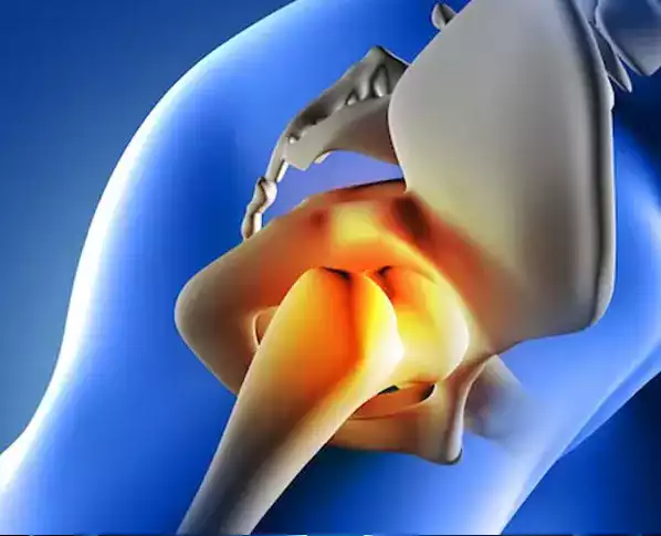 Total Knee Prosthesis
