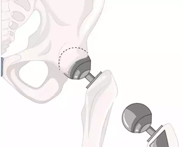 Hip Prosthesis Without Abbreviation
