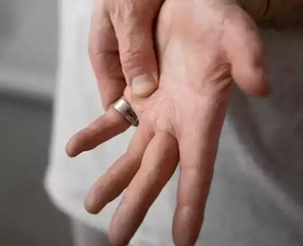 De Quervain Tendonitis
